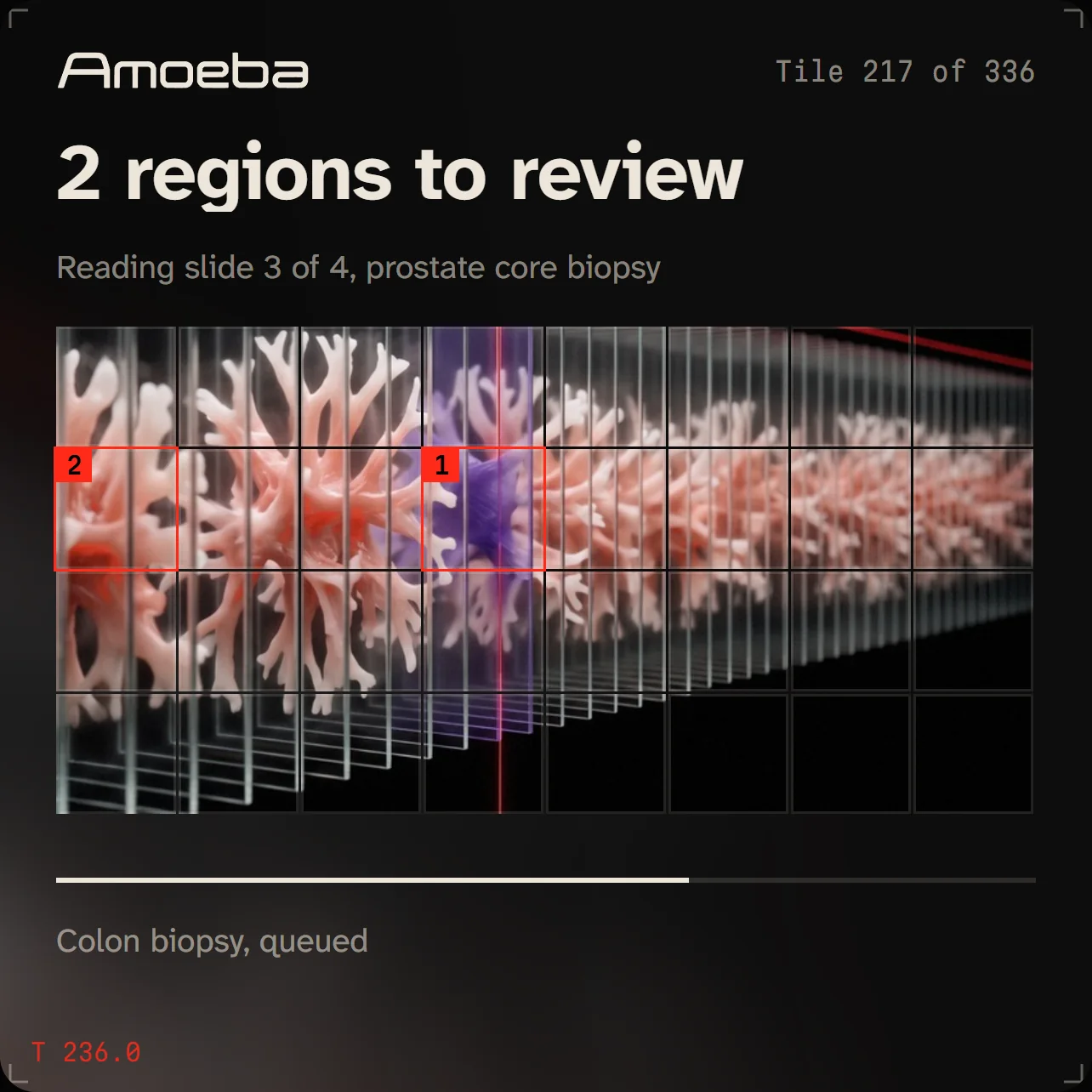 Amoeba's case view: 2 regions to review, flagged 1 and 2 on the tile map, a colon biopsy queued next